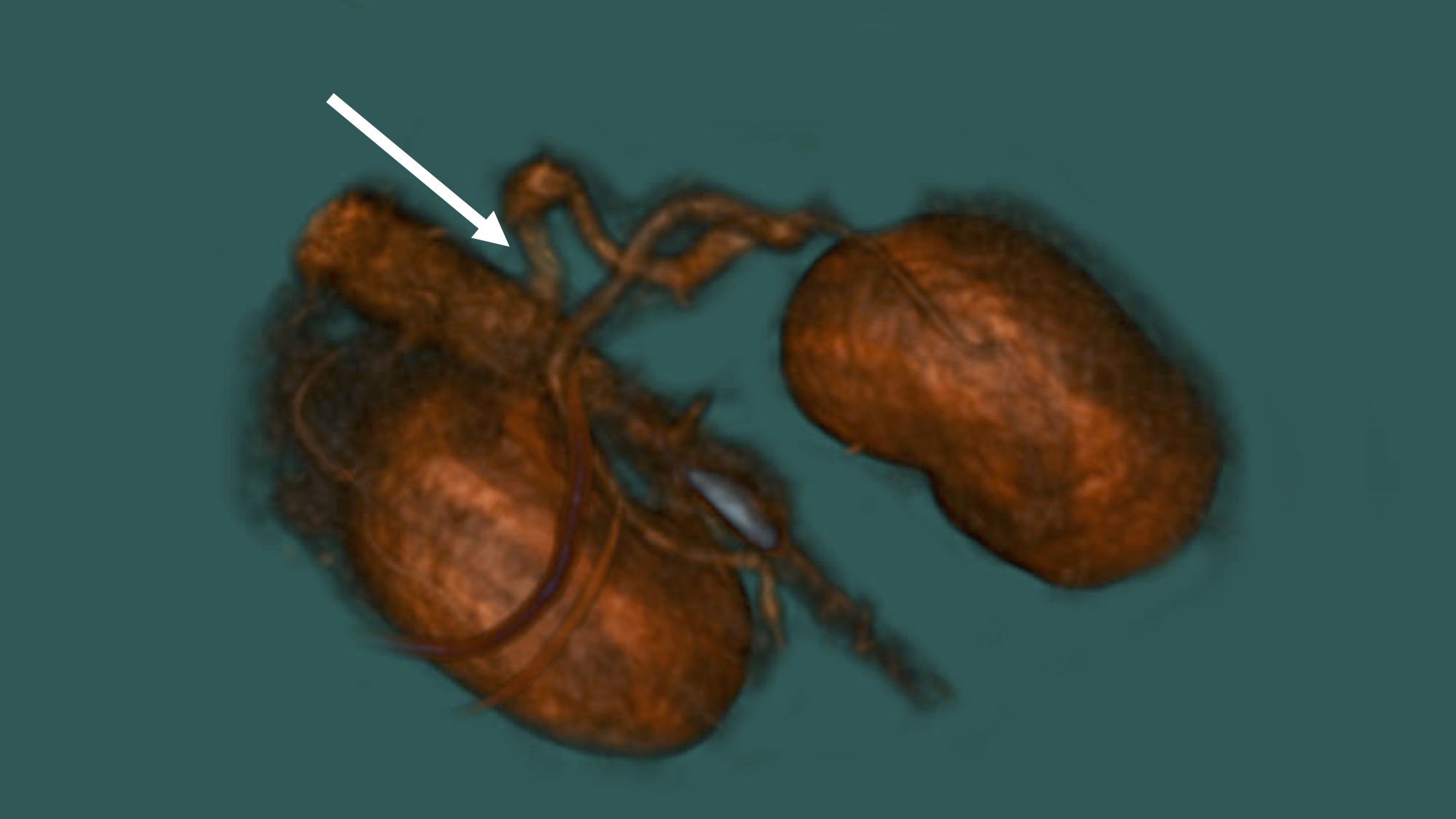 Two brown kidney-shaped organs connected by twisted vessels, with a white arrow pointing to the left side, on a dark green background.