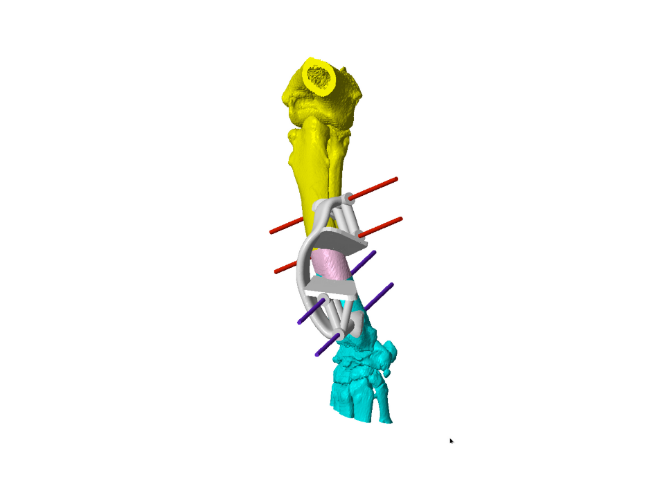 A model of Baxter's leg using 3D printing technology A multi-colored 3D model depicts a complex apparatus attached to bone segments, with red and purple rods stabilizing the structure. The yellow, pink, and blue sections represent different parts of the anatomy.