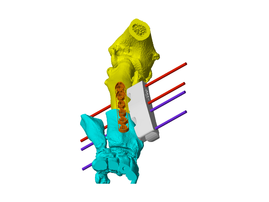 The model of Baxter's leg from a different angle A 3D-rendered anatomical model shows bones, possibly vertebrae, in blue and yellow, with a white support structure attached. Red and purple rods extend horizontally, emphasizing alignment or stabilization.